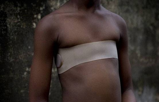 Breast ironing (flattening)