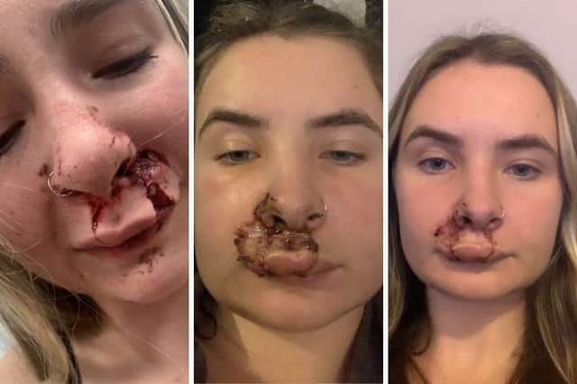 Ella Dowling injuries Ella Downing injuries